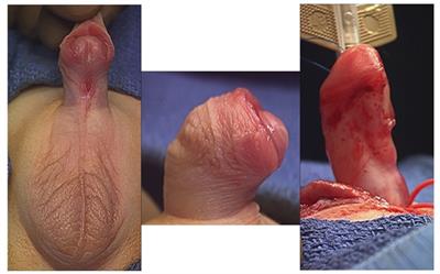 Management of High-Grade Penile Curvature Associated With Hypospadias in Children